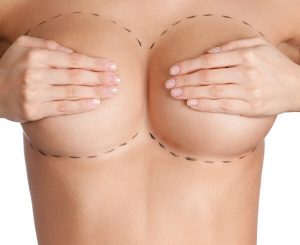 Is it possible for breast implants to create a swooping or slopped