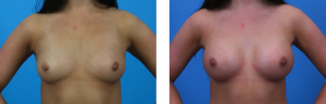 Results from breast augmentation with Dr. Evan Beale