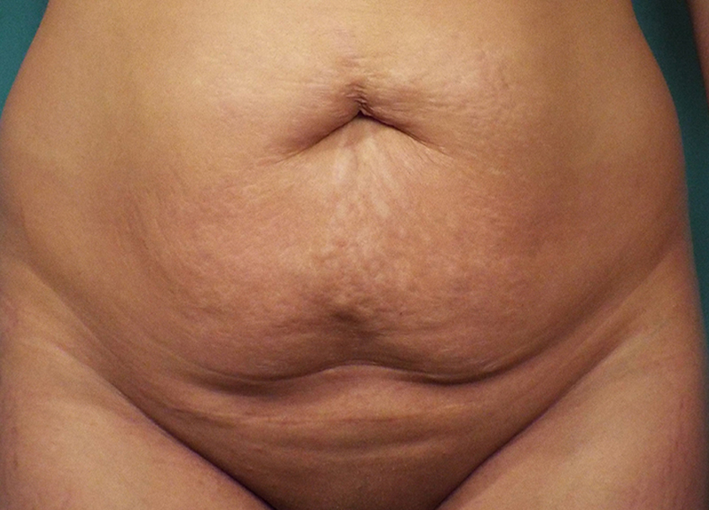 Abdominoplasty Before and After | Dr Evan W Beale