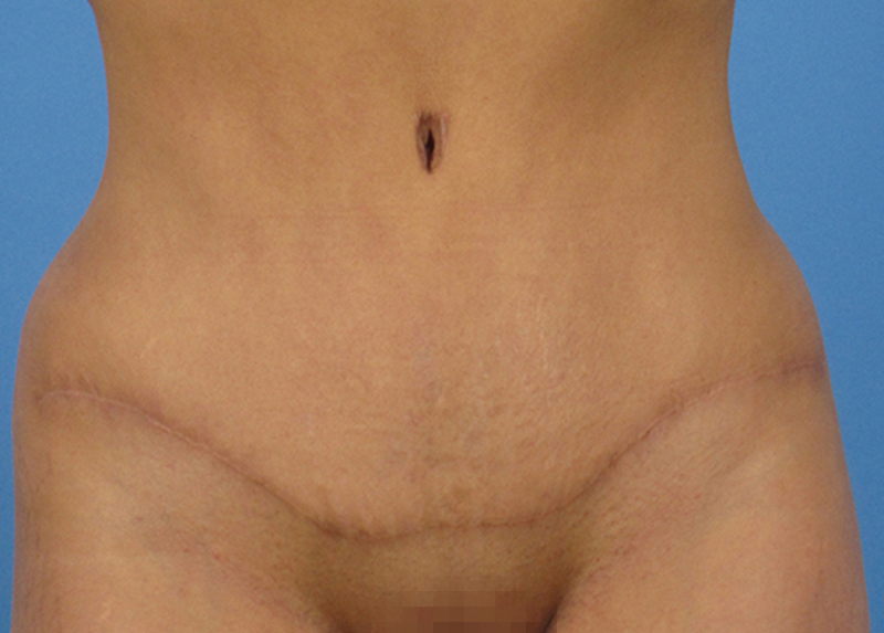 Abdominoplasty Before and After | Dr Evan W Beale