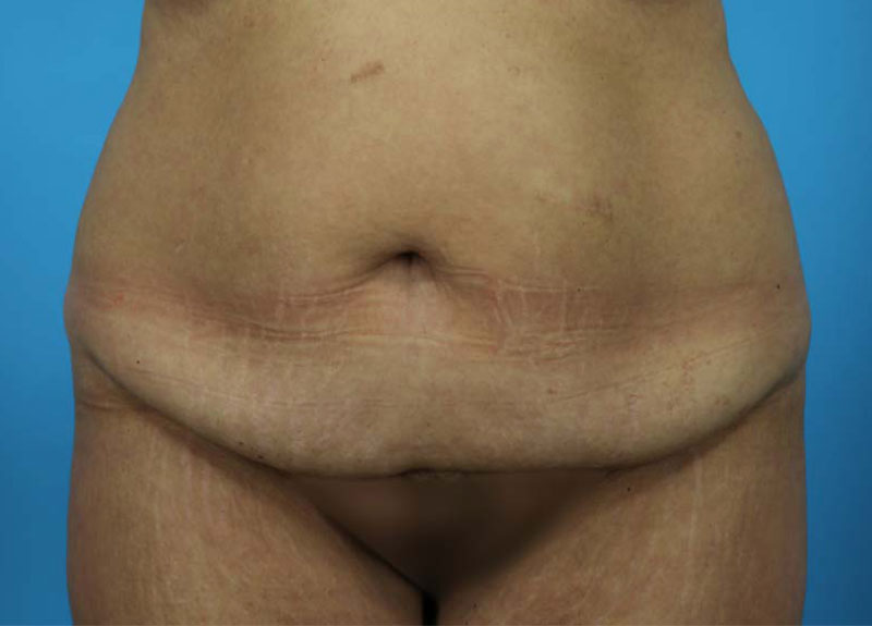Abdominoplasty Before and After | Dr Evan W Beale