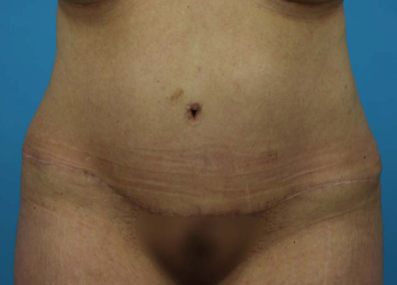 Abdominoplasty Before and After | Dr Evan W Beale