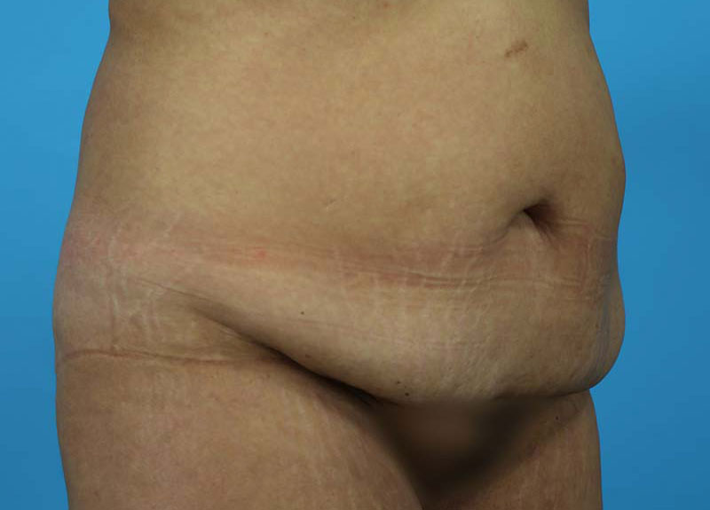 Abdominoplasty Before and After | Dr Evan W Beale