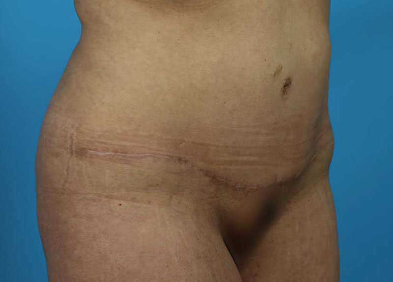 Abdominoplasty Before and After | Dr Evan W Beale