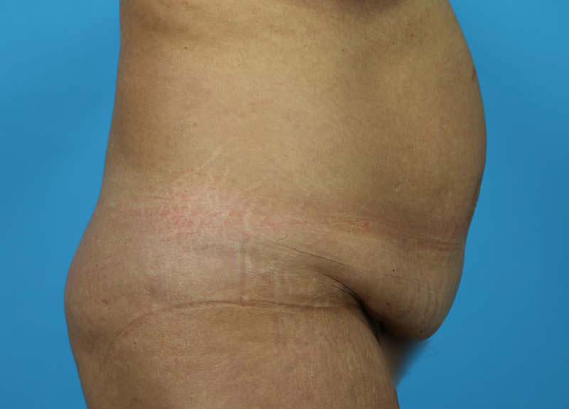 Abdominoplasty Before and After | Dr Evan W Beale