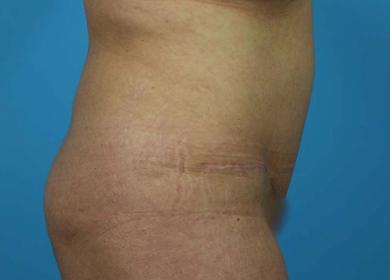 Abdominoplasty Before and After | Dr Evan W Beale