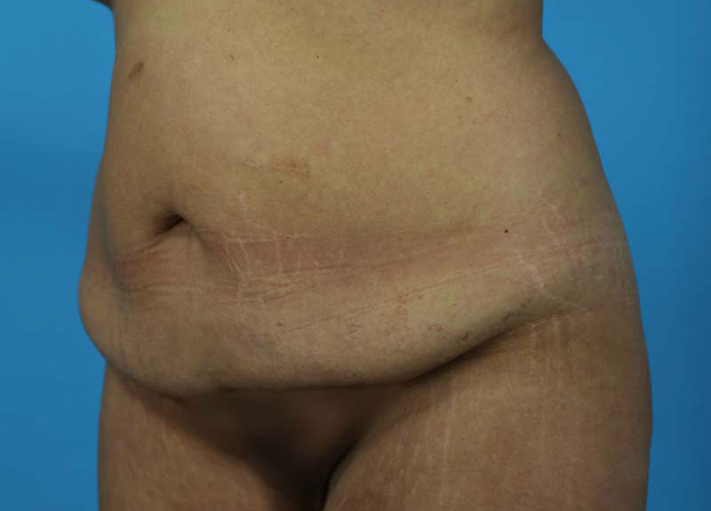 Abdominoplasty Before and After | Dr Evan W Beale