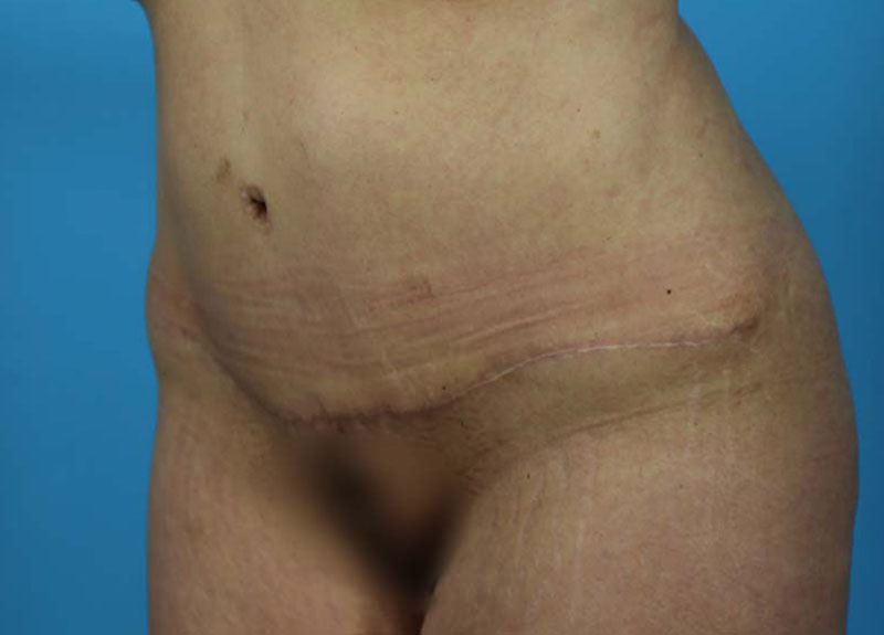 Abdominoplasty Before and After | Dr Evan W Beale