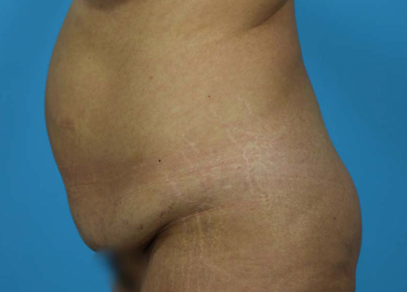 Abdominoplasty Before and After | Dr Evan W Beale