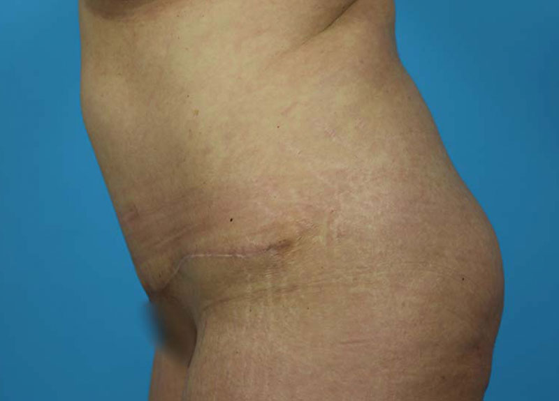 Abdominoplasty Before and After | Dr Evan W Beale