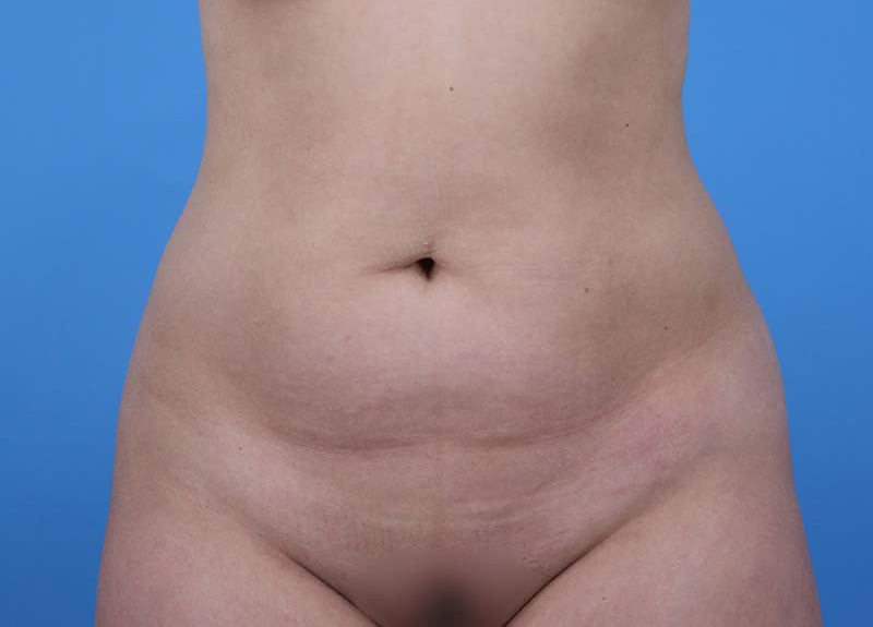 Abdominoplasty Before and After | Dr Evan W Beale