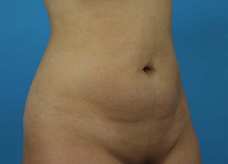 Abdominoplasty Before and After | Dr Evan W Beale