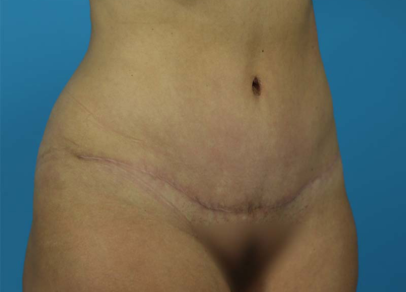 Abdominoplasty Before and After | Dr Evan W Beale