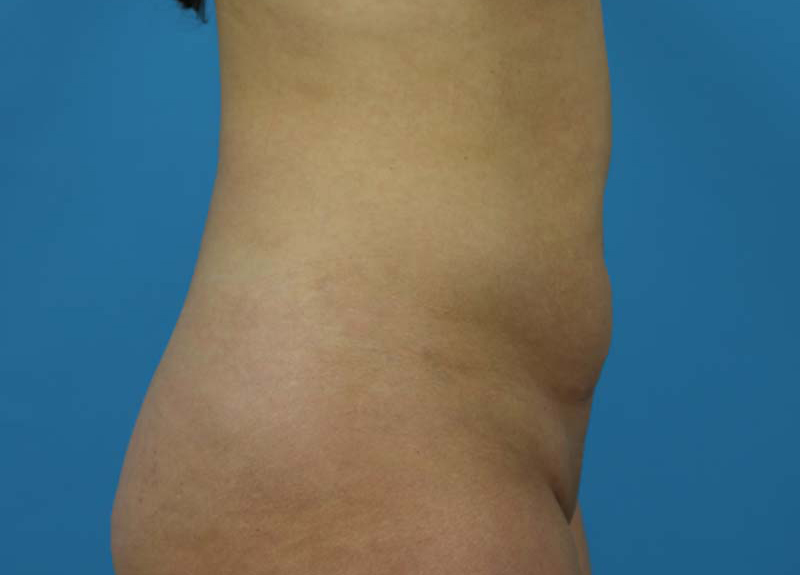 Abdominoplasty Before and After | Dr Evan W Beale