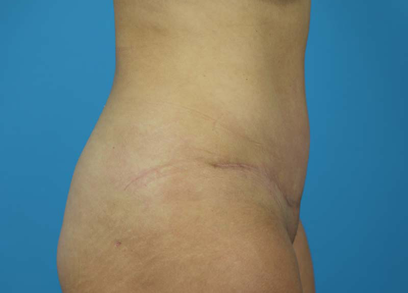 Abdominoplasty Before and After | Dr Evan W Beale