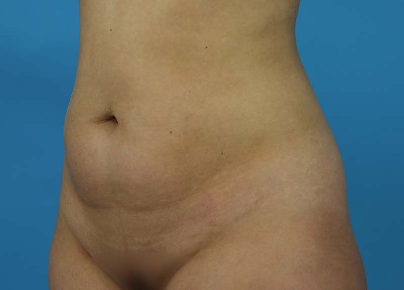 Abdominoplasty Before and After | Dr Evan W Beale