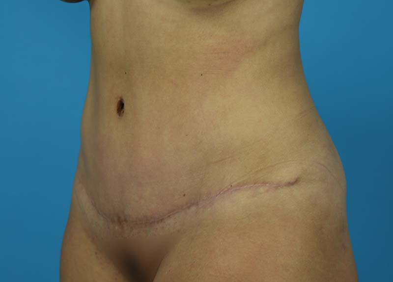 Abdominoplasty Before and After | Dr Evan W Beale