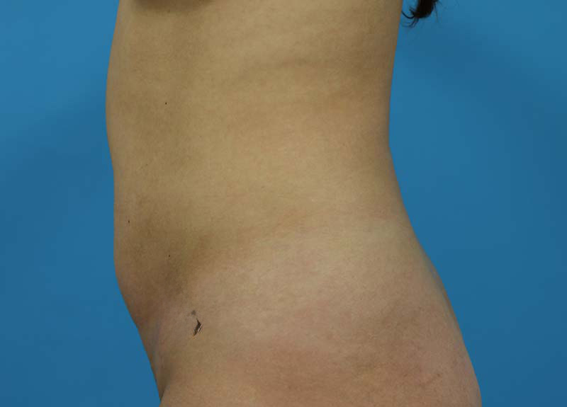 Abdominoplasty Before and After | Dr Evan W Beale