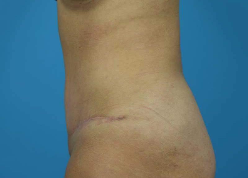 Abdominoplasty Before and After | Dr Evan W Beale