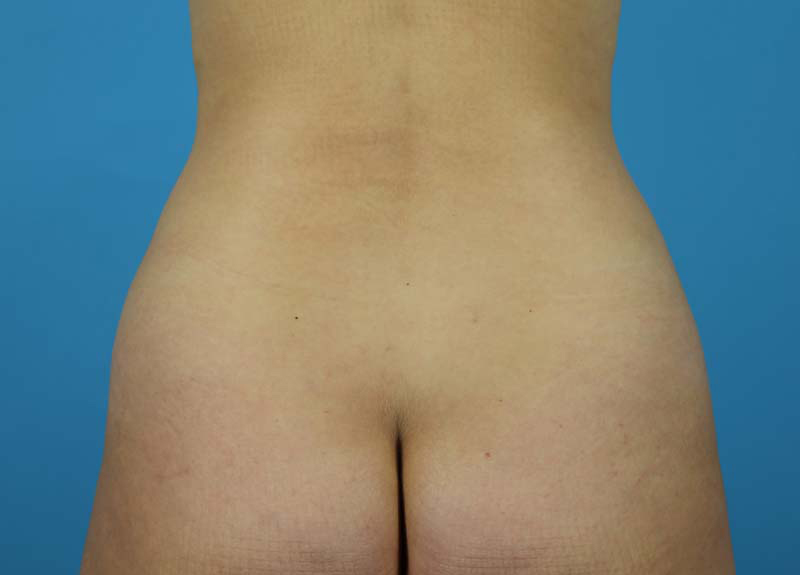 Abdominoplasty Before and After | Dr Evan W Beale