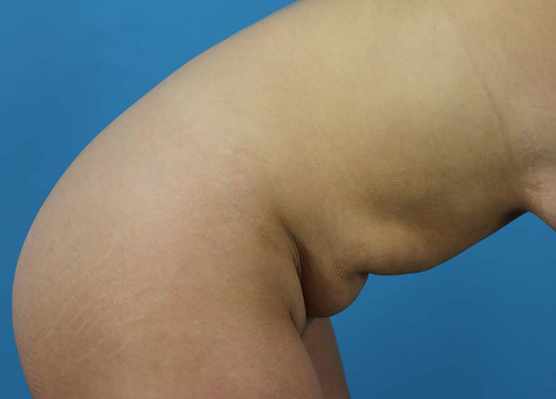 Abdominoplasty Before and After | Dr Evan W Beale