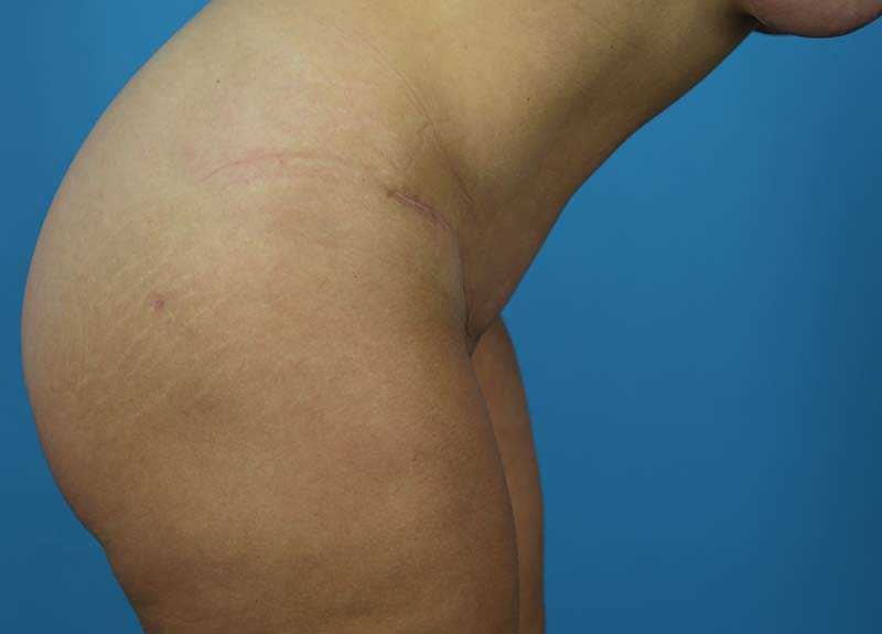 Abdominoplasty Before and After | Dr Evan W Beale