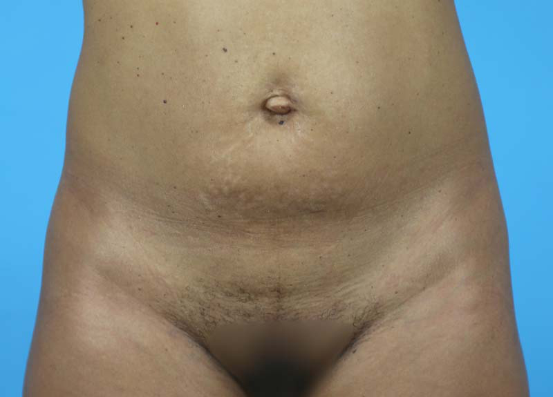 Abdominoplasty Before and After | Dr Evan W Beale