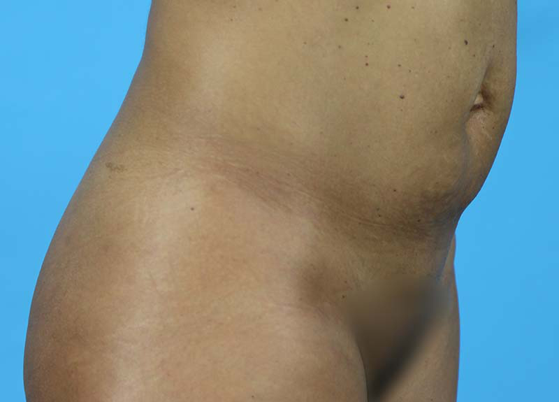 Abdominoplasty Before and After | Dr Evan W Beale