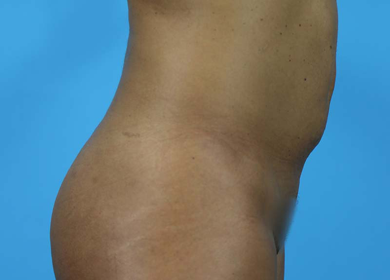 Abdominoplasty Before and After | Dr Evan W Beale