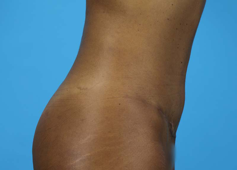 Abdominoplasty Before and After | Dr Evan W Beale