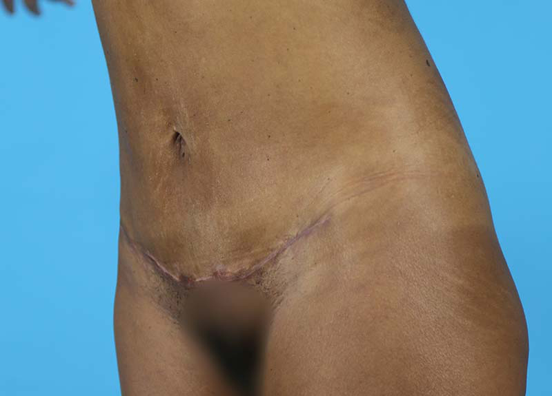 Abdominoplasty Before and After | Dr Evan W Beale