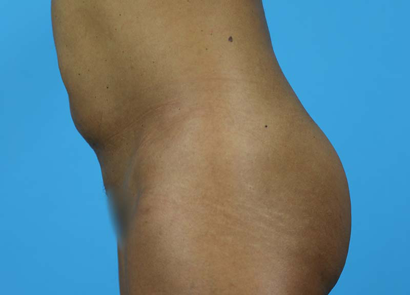 Abdominoplasty Before and After | Dr Evan W Beale