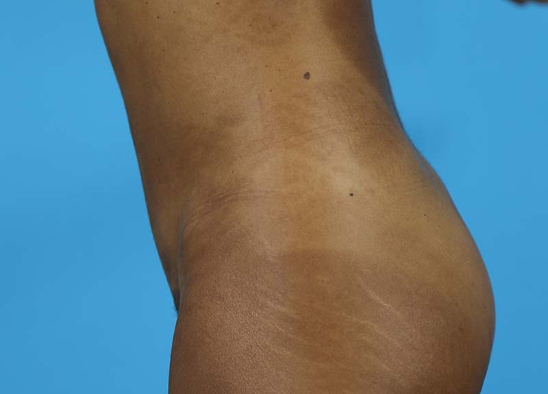 Abdominoplasty Before and After | Dr Evan W Beale