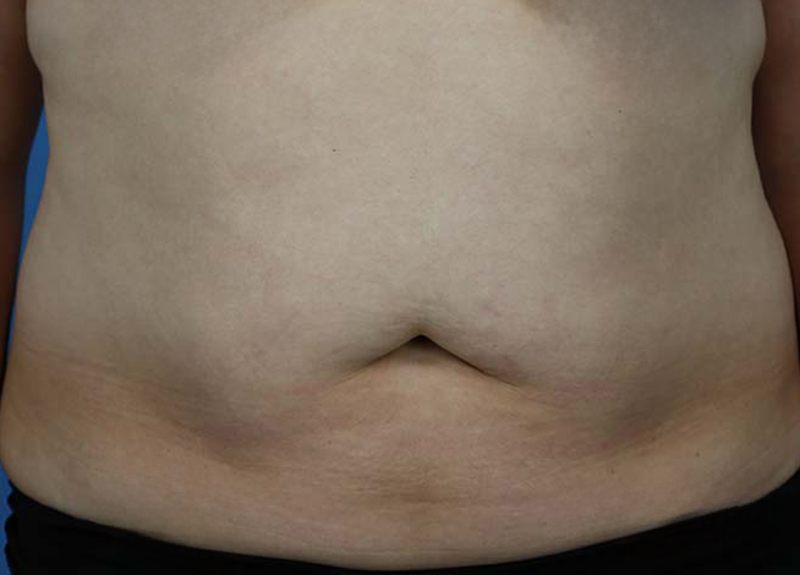 Abdominoplasty Before and After | Dr Evan W Beale