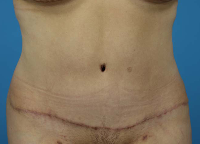 Abdominoplasty Before and After | Dr Evan W Beale