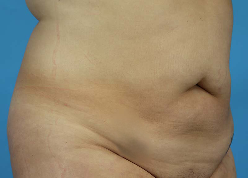 Abdominoplasty Before and After | Dr Evan W Beale