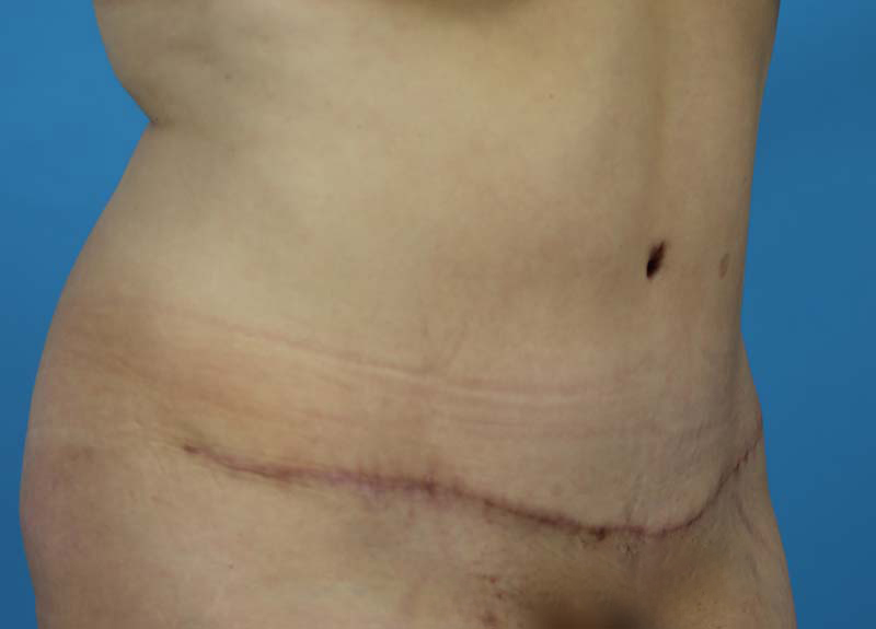 Abdominoplasty Before and After | Dr Evan W Beale