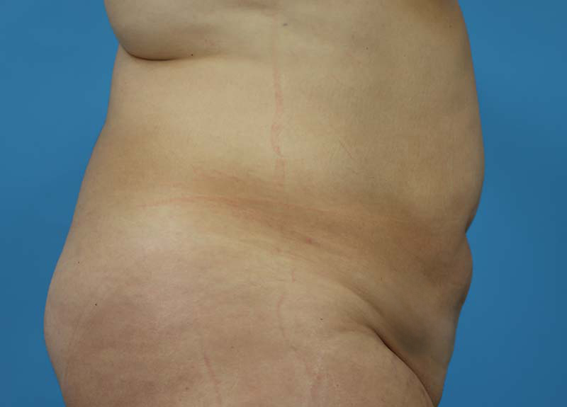 Abdominoplasty Before and After | Dr Evan W Beale