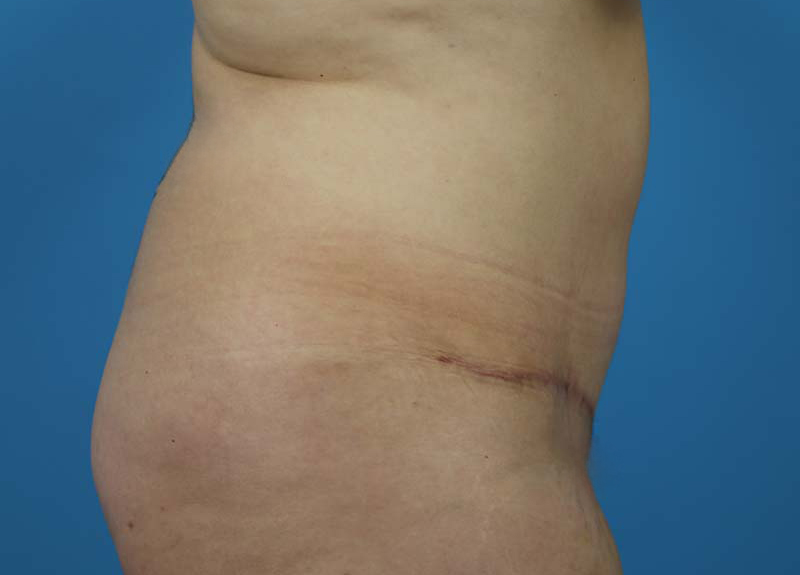 Abdominoplasty Before and After | Dr Evan W Beale