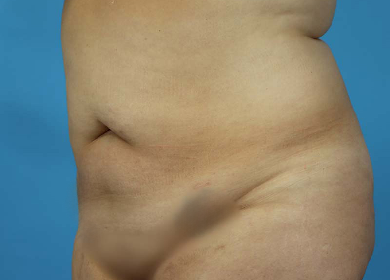 Abdominoplasty Before and After | Dr Evan W Beale