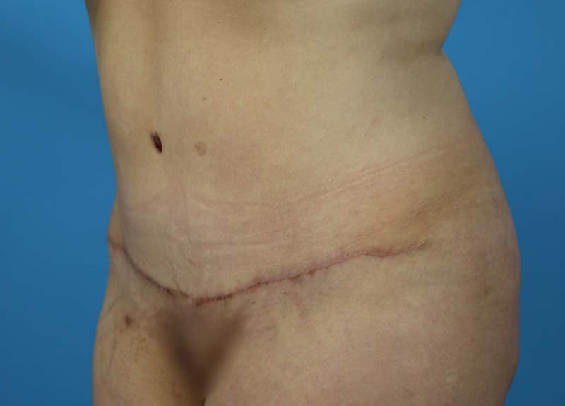 Abdominoplasty Before and After | Dr Evan W Beale