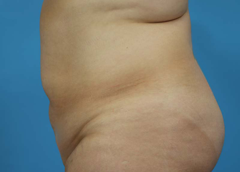Abdominoplasty Before and After | Dr Evan W Beale