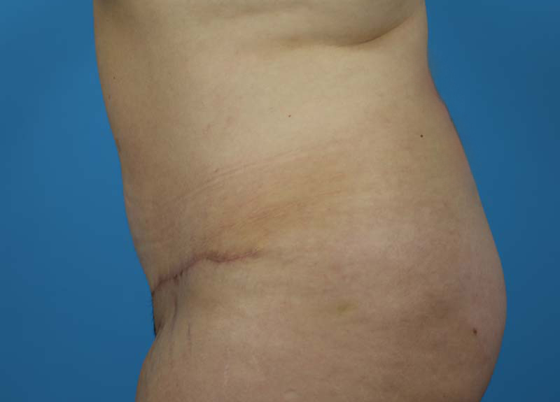 Abdominoplasty Before and After | Dr Evan W Beale