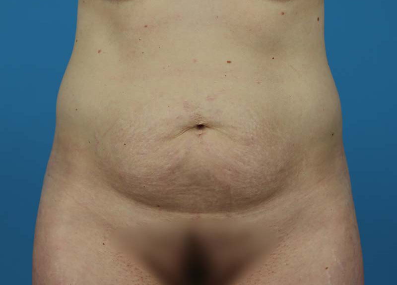 Abdominoplasty Before and After | Dr Evan W Beale