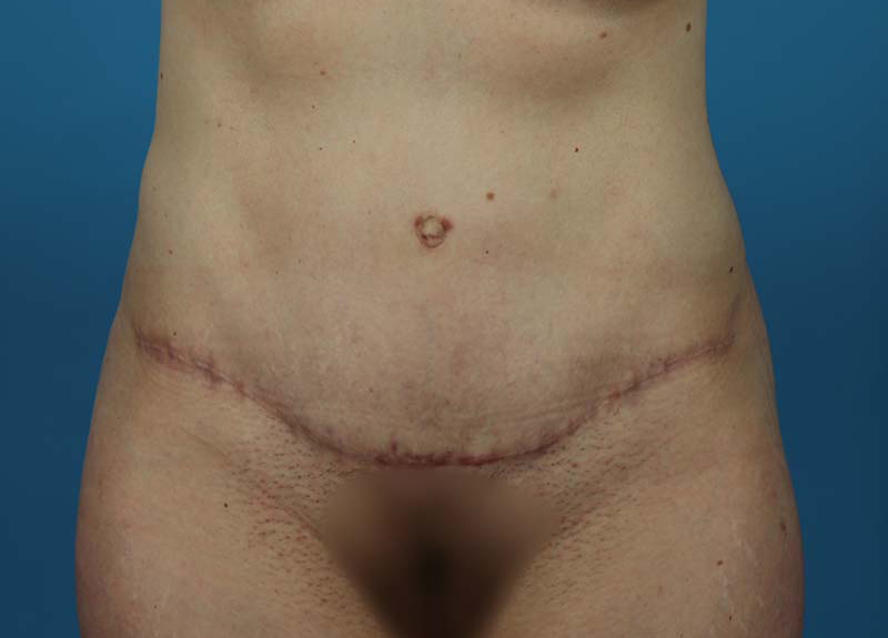 Abdominoplasty Before and After | Dr Evan W Beale