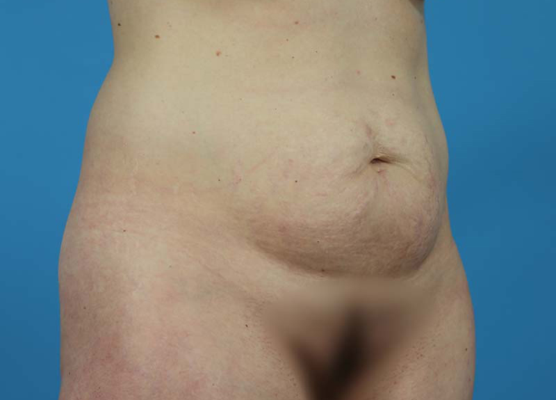 Abdominoplasty Before and After | Dr Evan W Beale
