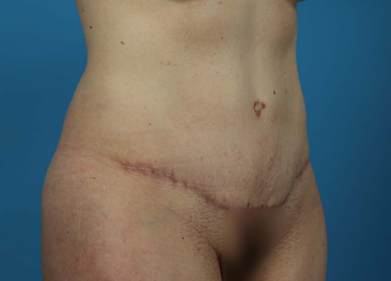 Abdominoplasty Before and After | Dr Evan W Beale