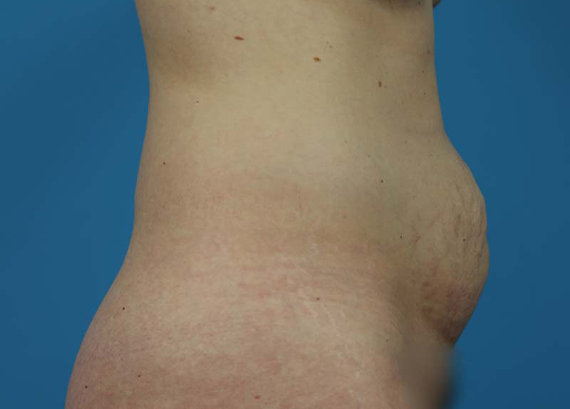 Abdominoplasty Before and After | Dr Evan W Beale