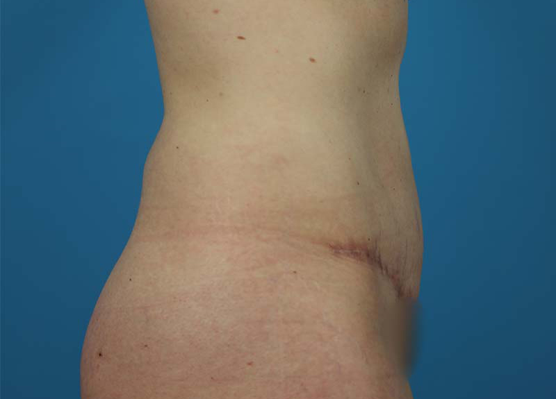 Abdominoplasty Before and After | Dr Evan W Beale