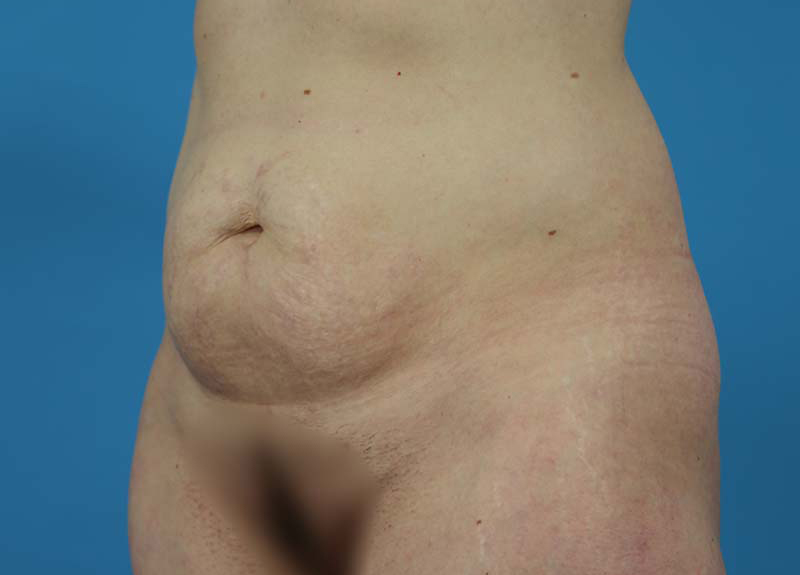 Abdominoplasty Before and After | Dr Evan W Beale